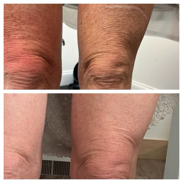 Morpheus8 for Body b&a