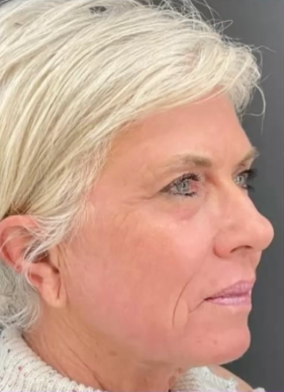 Laser Skin Before & After