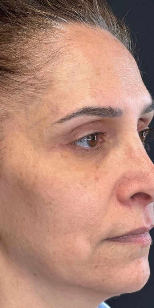 Full Face Correction Before & After