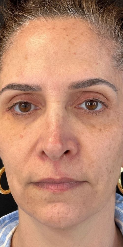 Full Face Correction Before & After