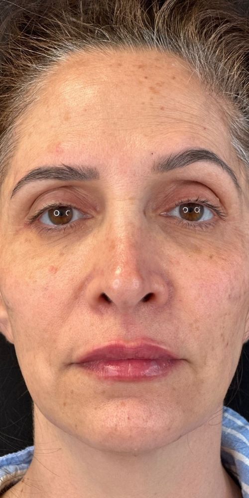 Full Face Correction Before & After