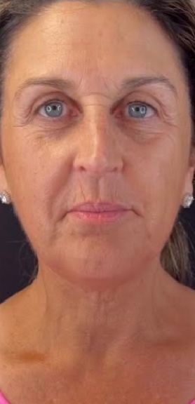 Morpheus Before & After