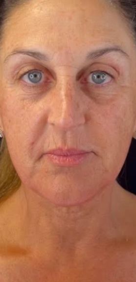 Morpheus Before & After