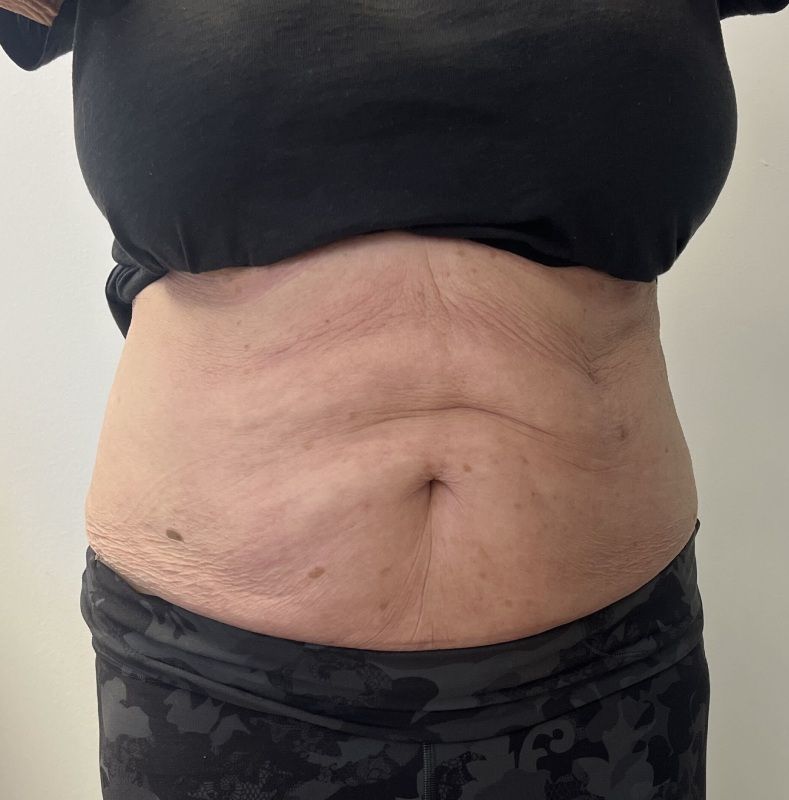 Morpheus8 Before & After