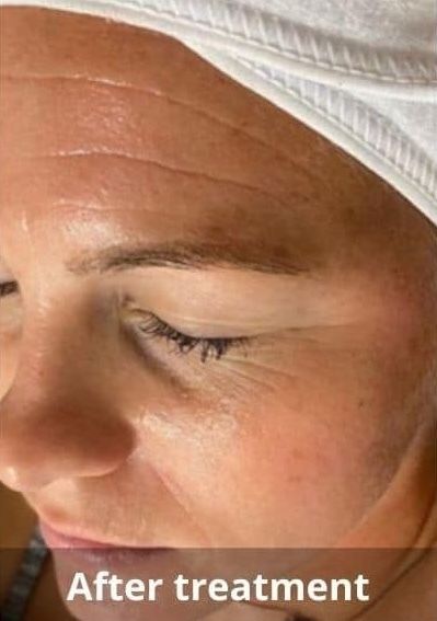 Jet Peel  Before & After