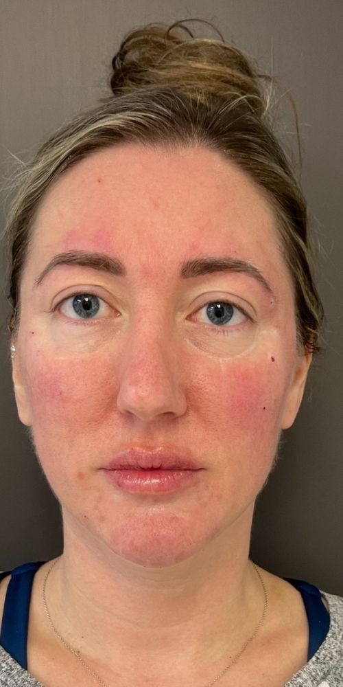 Dermal Filler Before & After