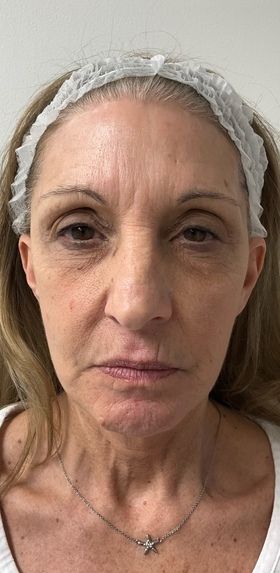 Dermal Filler Before & After