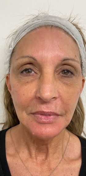 Dermal Filler Before & After