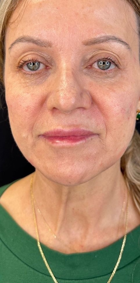 Dermal Filler Before & After