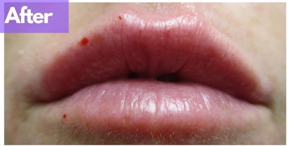 Lip Filler Before & After
