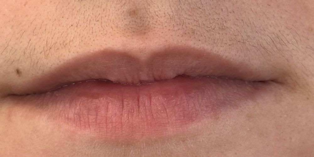 Lip Filler Before & After
