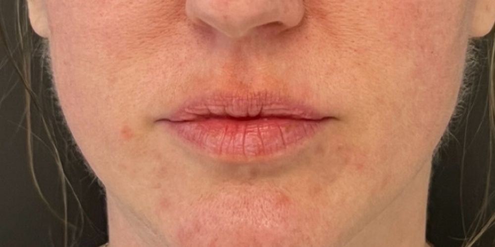 Lip Filler Before & After